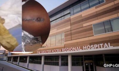 Ridge Hospital doctor left towel in a woman’s stomach for 9 months after C-section 52