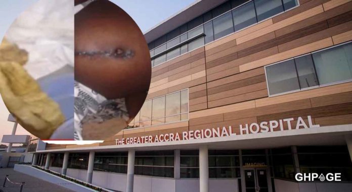 Ridge Hospital doctor left towel in a woman’s stomach for 9 months after C-section 49