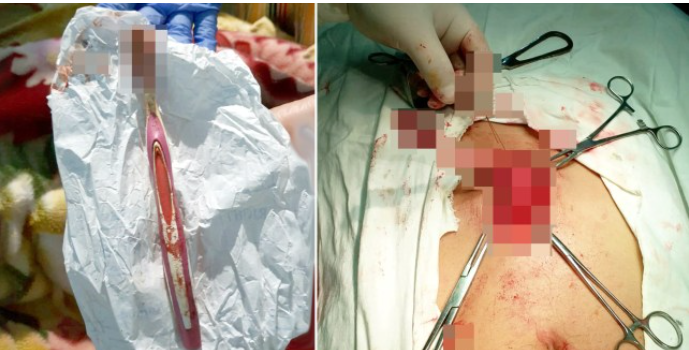 Shocking; See What Doctors Found In The Stomach Of An Obese Man - [Photos] 53