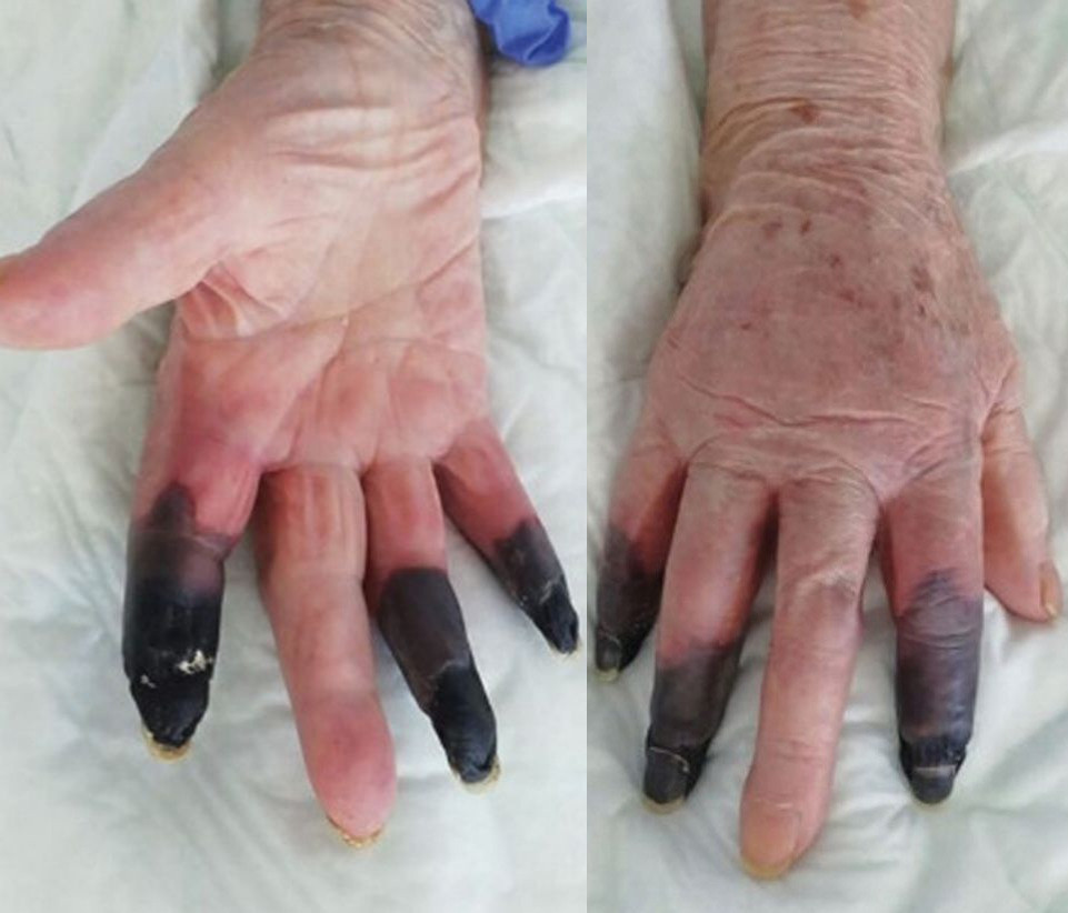 Covid-19 symptoms: Patient's fingers turn black [Photos] 51