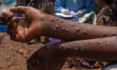 Ghana Health Service report highlights rise in Mpox cases to 170 as of July 6.