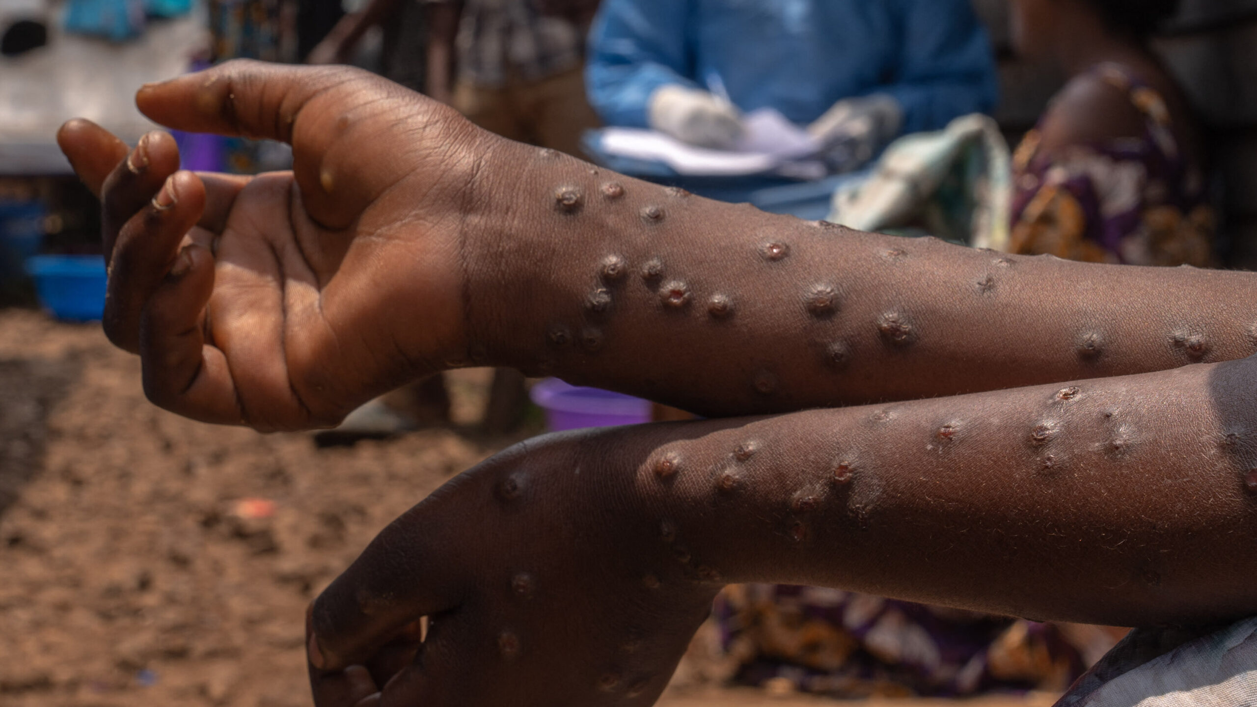 Ghana Health Service report highlights rise in Mpox cases to 170 as of July 6.